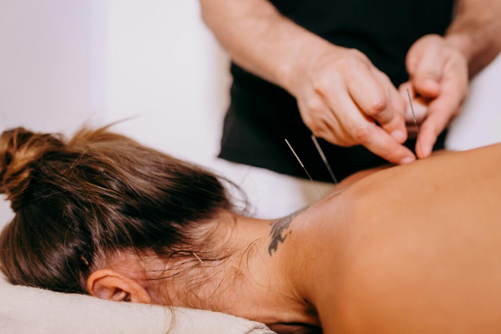 woman being treated with acupuncture