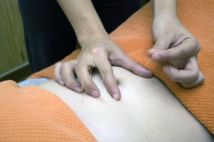 Acupuncturist inserting needles on the abdomen.