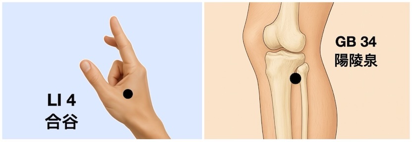 LI 4 Hegu point on the dorsum of the hand, on the fleshy mound of the webbing, between the 1st and 2nd metacarpal bones and GB 34 Yanglingquan point on the leg in the depression anterior and inferior to the head of the fibula